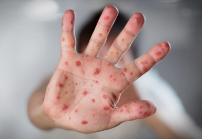 Седум новозаболени од морбили, во животозагрозувачка состојба пациент на Инфективна клиника