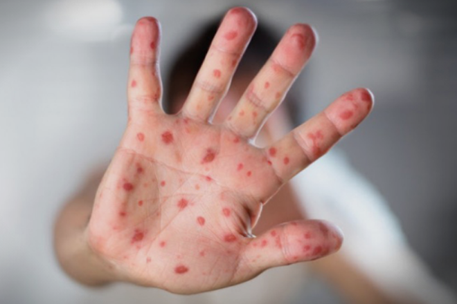 Николов: Се соочуваме со врвот на епидемијата на морбили, а од министерството за здравство единствено се зборува за некакви физибилити студии