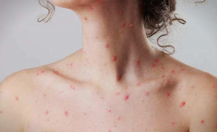 ИЈЗ: Регистриран сомнителен случај на мали сипаници