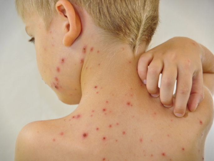 Прогласена епидемија на варичела во Крива Паланка и Ранковце, заболени 73 деца