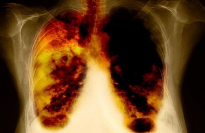 Пијалок за отстранување на катранот и токсините од белите дробови