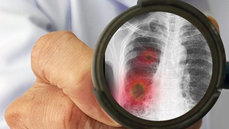 Овој параметар на крвната слика е најчуден кај оние тешки случаи на Ковид-19